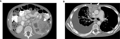 Novel Patient Metastatic Pleural Effusion-Derived Xenograft Model of Renal Medullary Carcinoma Demonstrates Therapeutic Efficacy of Sunitinib